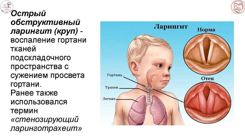 Ларингит у детей: симптомы и 4 схемы лечения