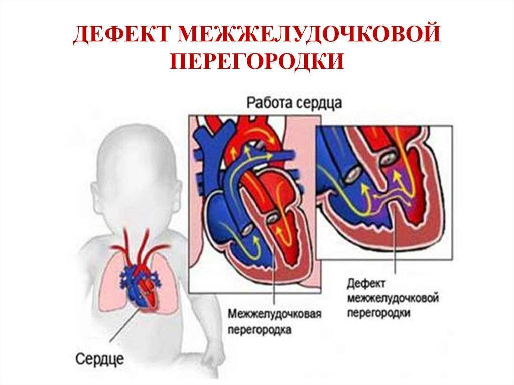 'белые' пороки сердца: анатомические особенности и способы коррекции  . классификация пороков сердца у детей