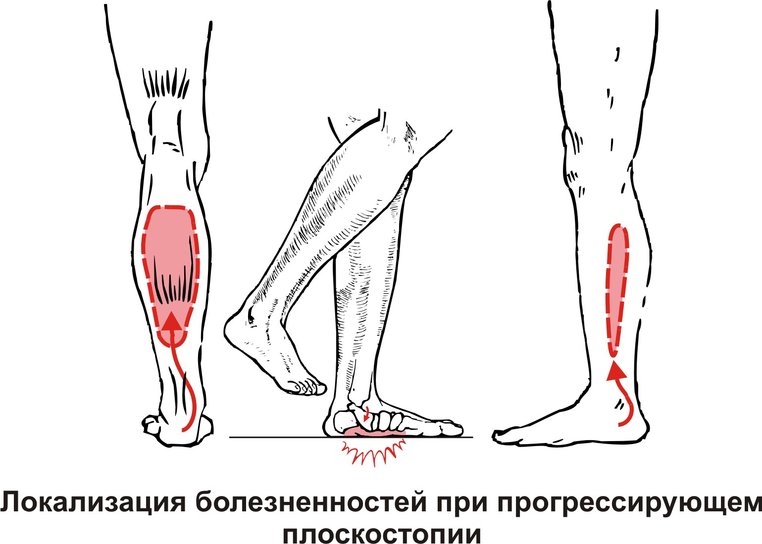 Колика в ноге лечение. Мышцы стопы плоскостопие. Судорога икроножной мышцы.