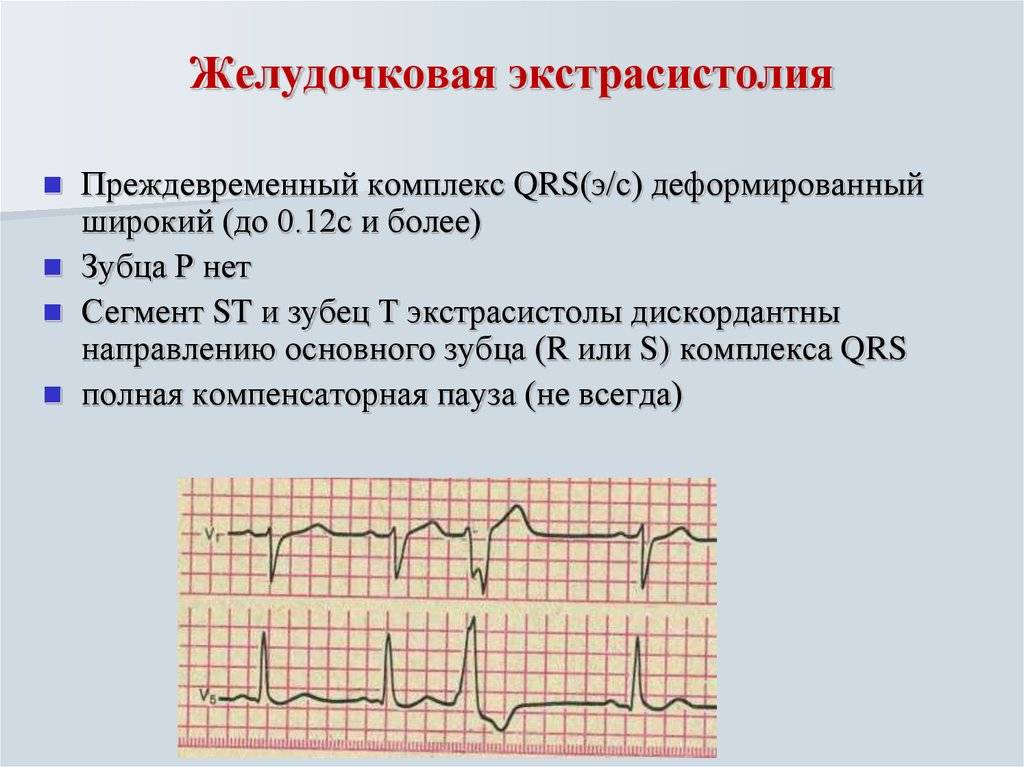 Желудочковая экстрасистолия у детей: 12 причин, 6 симптомов, лечение, осложнения, профилактика