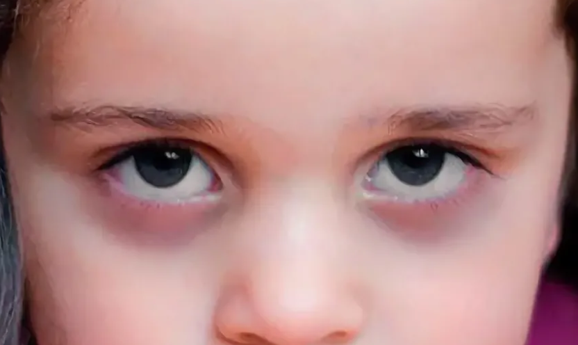 Синяки под глазами у ребенка: причины, почему, красные