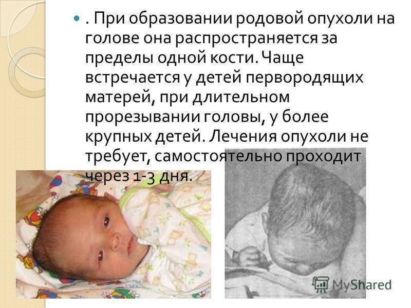 Кефалогематома у новорожденных на голове: последствия и лечение