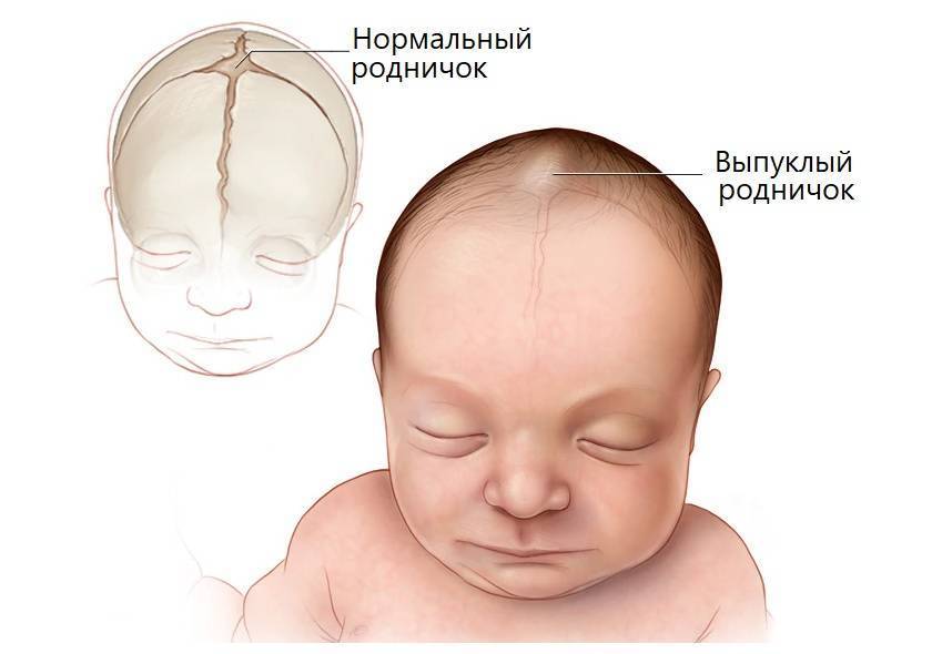 Детский родничок: размеры родничков у детей, сроки, когда зарастает родничок