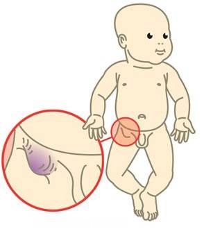 Что делать, если у новорождённого мальчика не опустились яички. причины и последствия