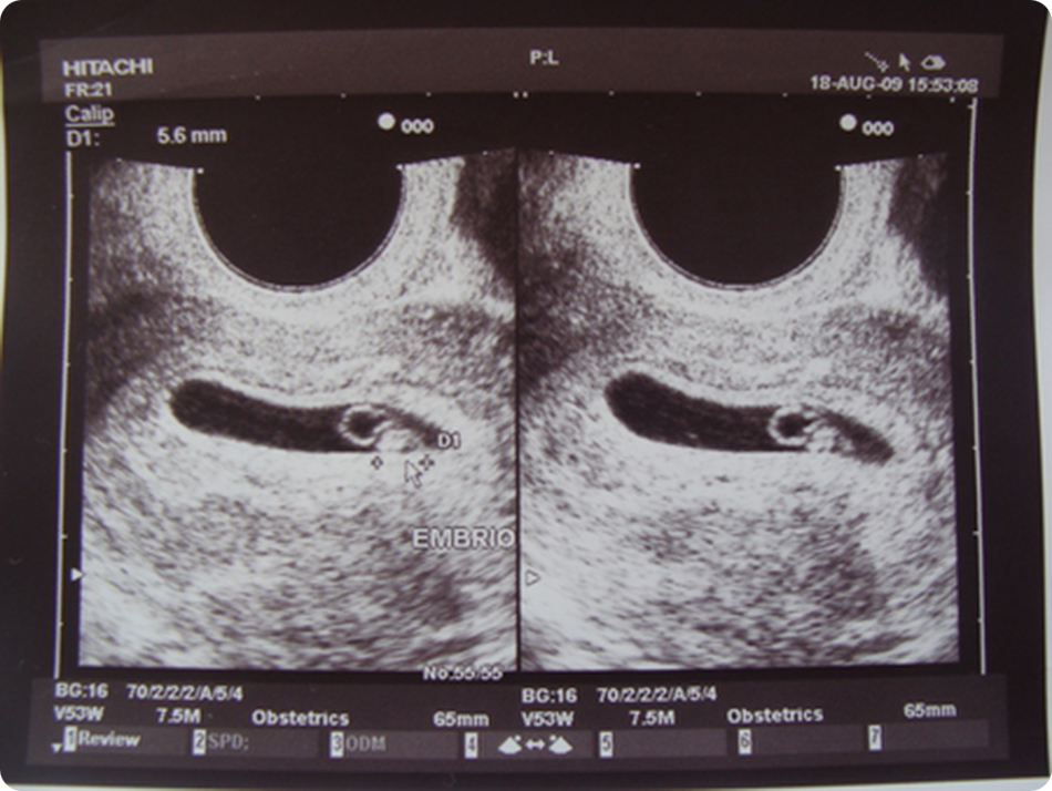 5 неделя операция. УЗИ 4-5 недель беременности. УЗИ 5 недель беременности фото. УЗИ на 5 неделе беременности.