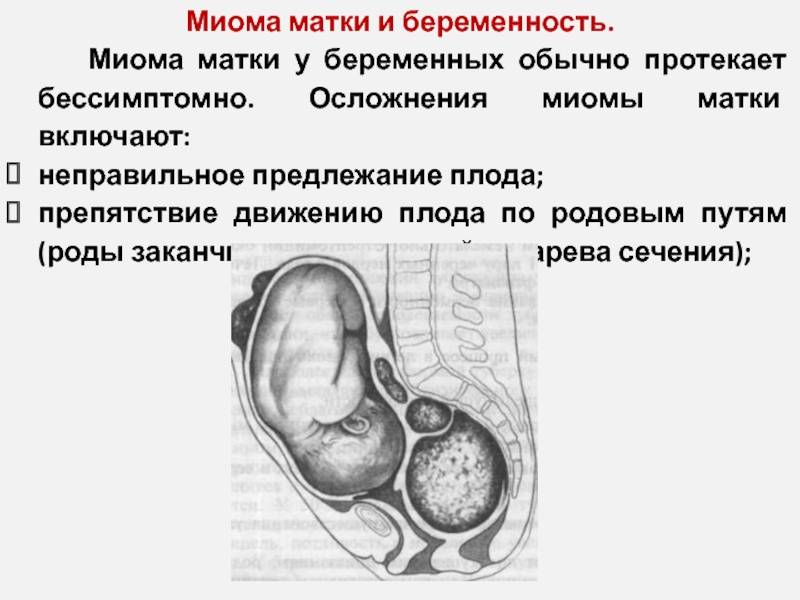 Миома матки — как вылечить опухоль без операции