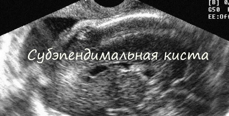 Псевдокиста головного мозга у новорожденных детей: причины и методы лечения | parnas42.ru