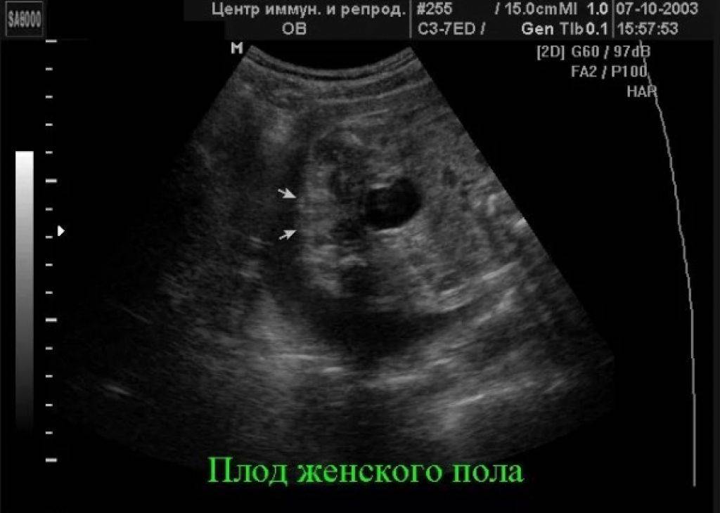 15 недель беременности узнать пол