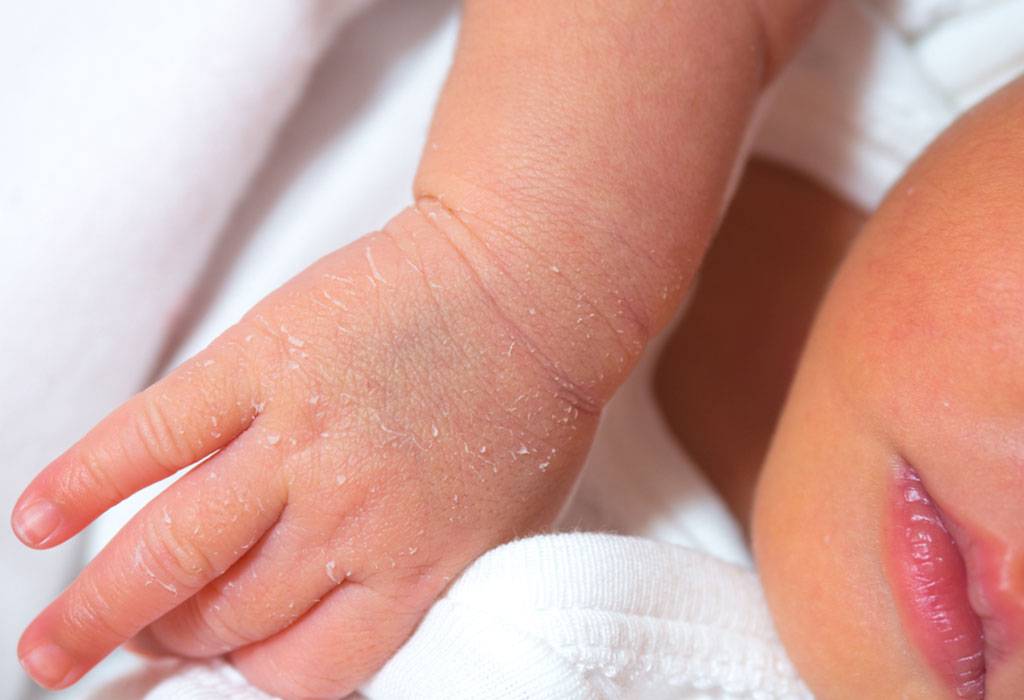 Почему шелушится кожа у новорожденного ребенка: всё о шелушении и сухости кожи у младенца