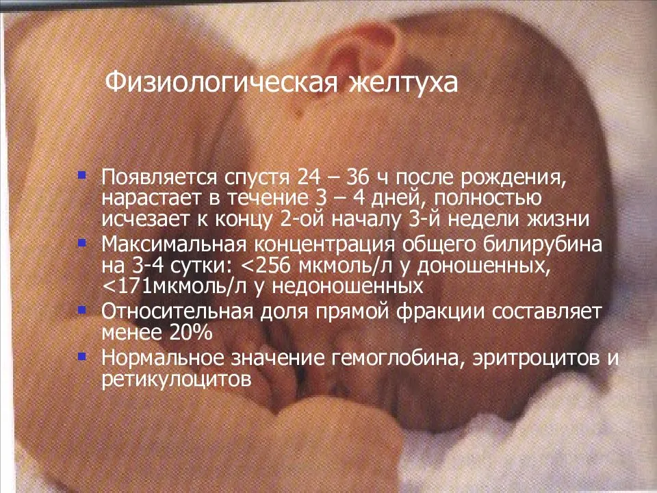 Желтуха у новорожденных: признаки, лечение, когда должна пройти