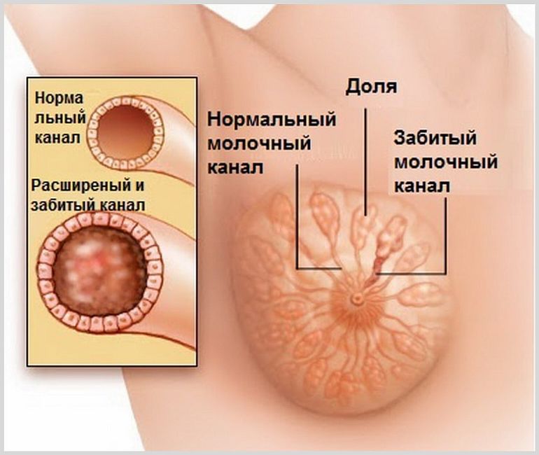 Симптомы и порядок лечения лактостаза у кормящей матери
