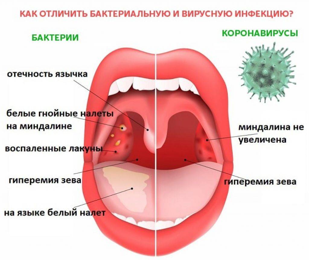 Хронический тонзиллит у детей