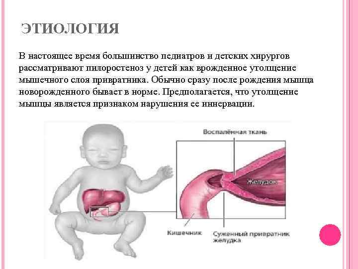 Что такое пилоростеноз у новорожденных: симптомы, причины, лечение
