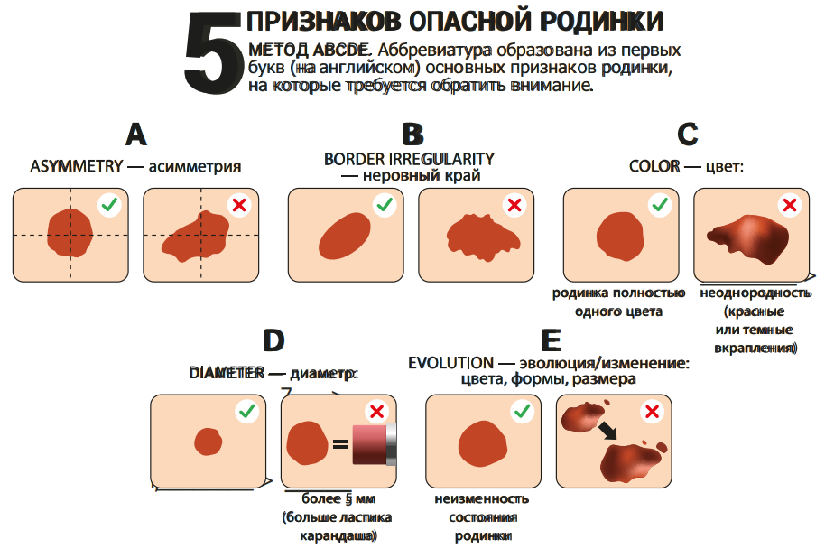 Появление, разрастание или изменение формы родинок у детей: виды, лечение