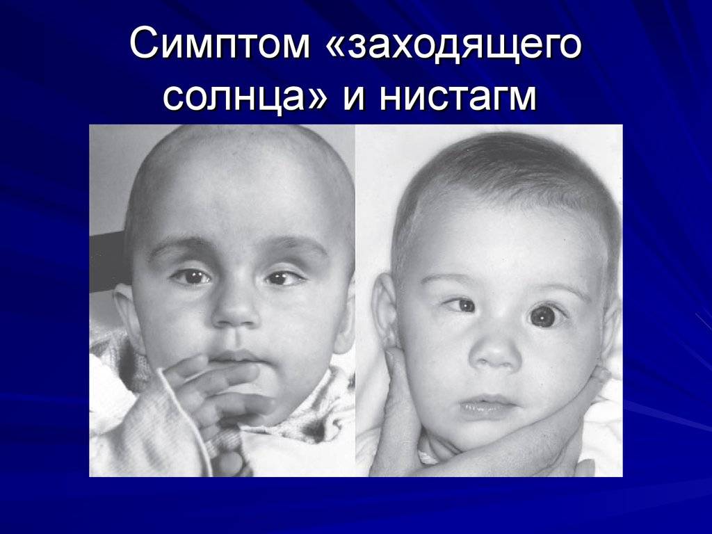 Синдром грефе у новорожденных: причины, признаки, методы лечения, профилактика