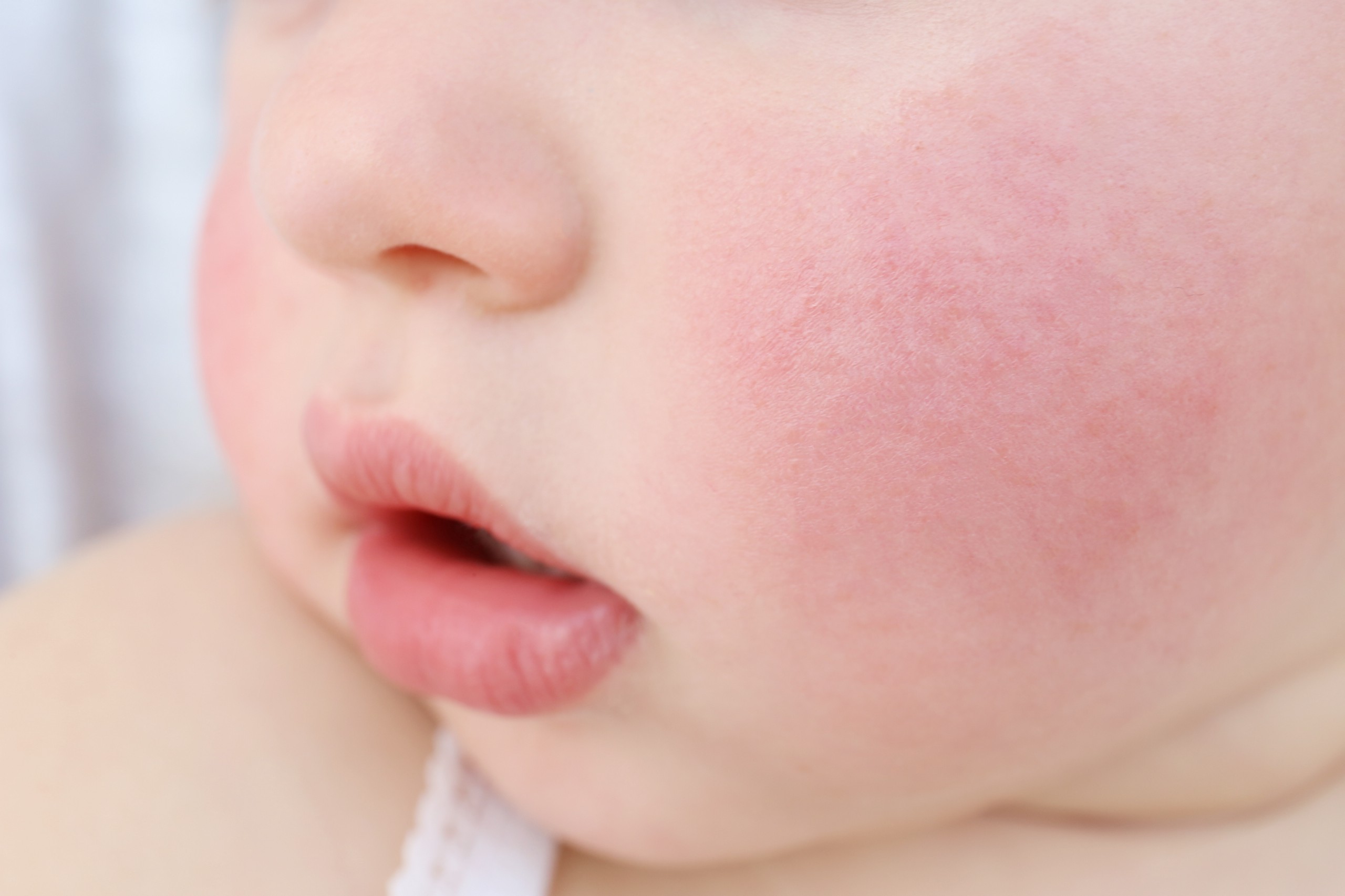 Ребенку год красные щеки. Гнейс атопический дерматит. Экссудативно катаральный диатез. Атопический дерматит у младенца.