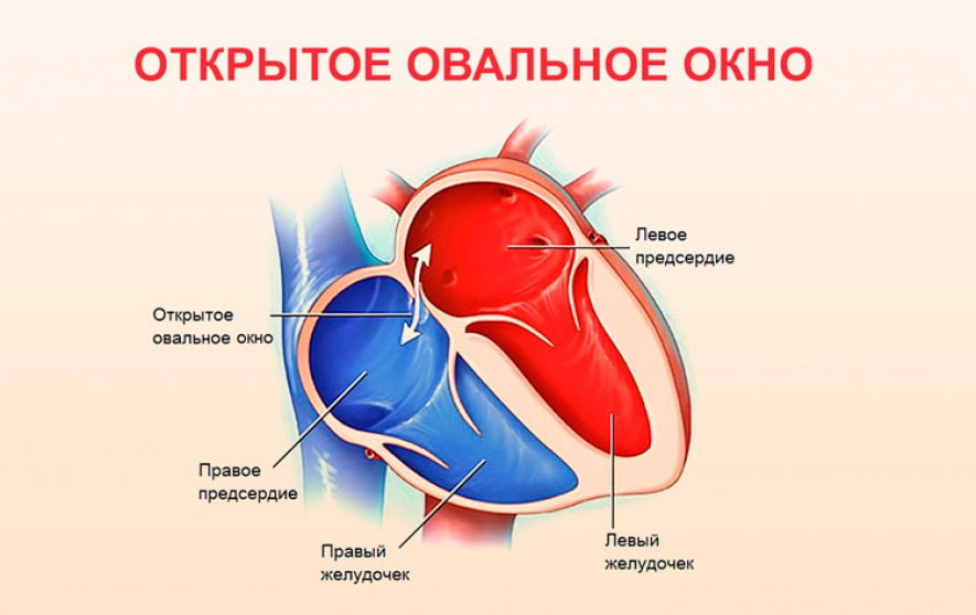 Открытое овальное окно в сердце у ребенка: 9 причин, 5 симптомов, чем опасно, лечение, последствия