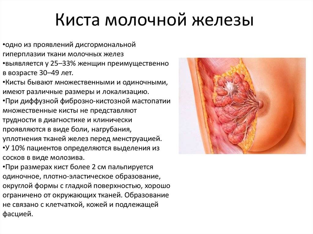 Шишка в груди при грудном вскармливании
