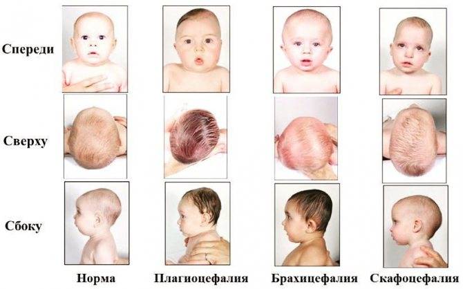 Большая голова у новорожденного — причины, болезнь