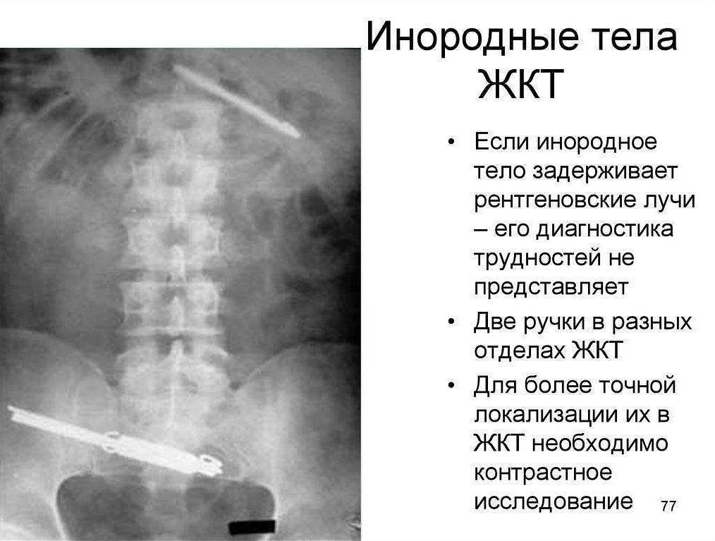 Ребёнок проглотил посторонний предмет: что делать | дети и родители | здоровье | аиф аргументы и факты в беларуси