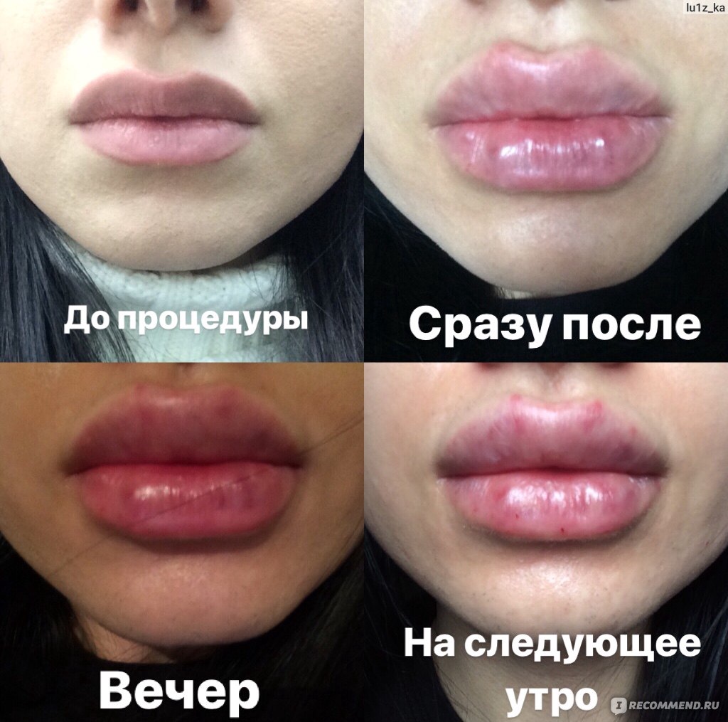Что произойдет, если увеличить губы при гв