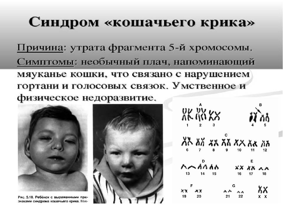 Синдром патау у детей: признаки и причины