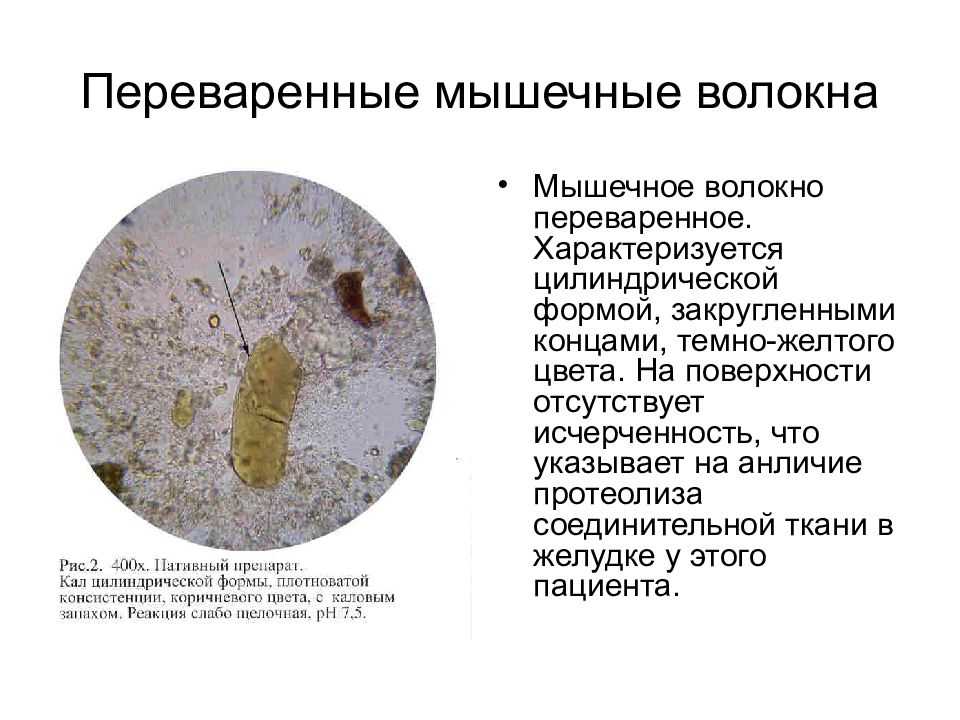Непереваренные мышечные волокна в кале у ребенка в копрограмме