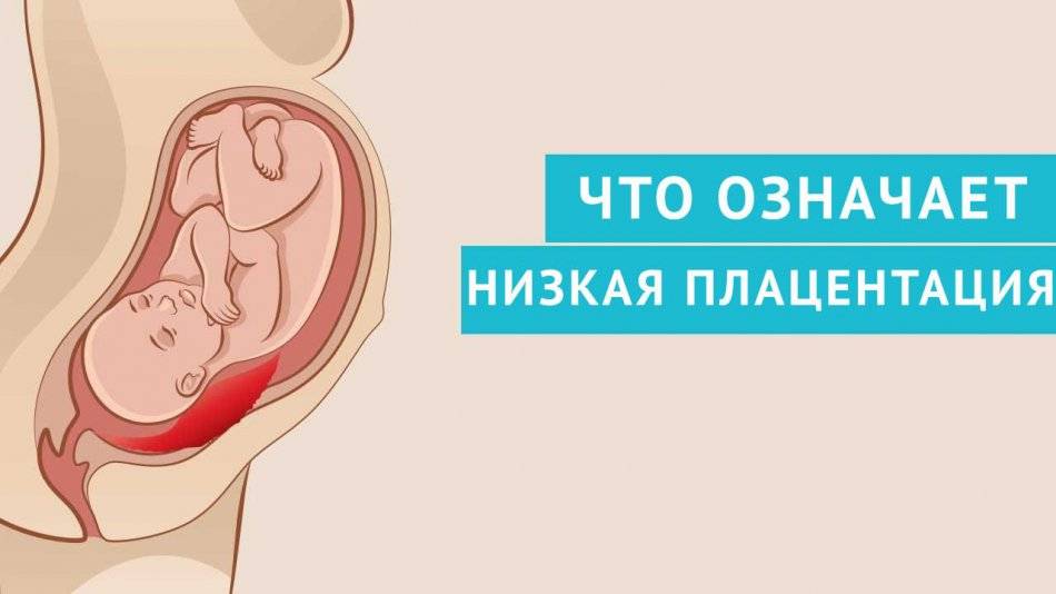 Низкая плацентация при беременности | уроки для мам