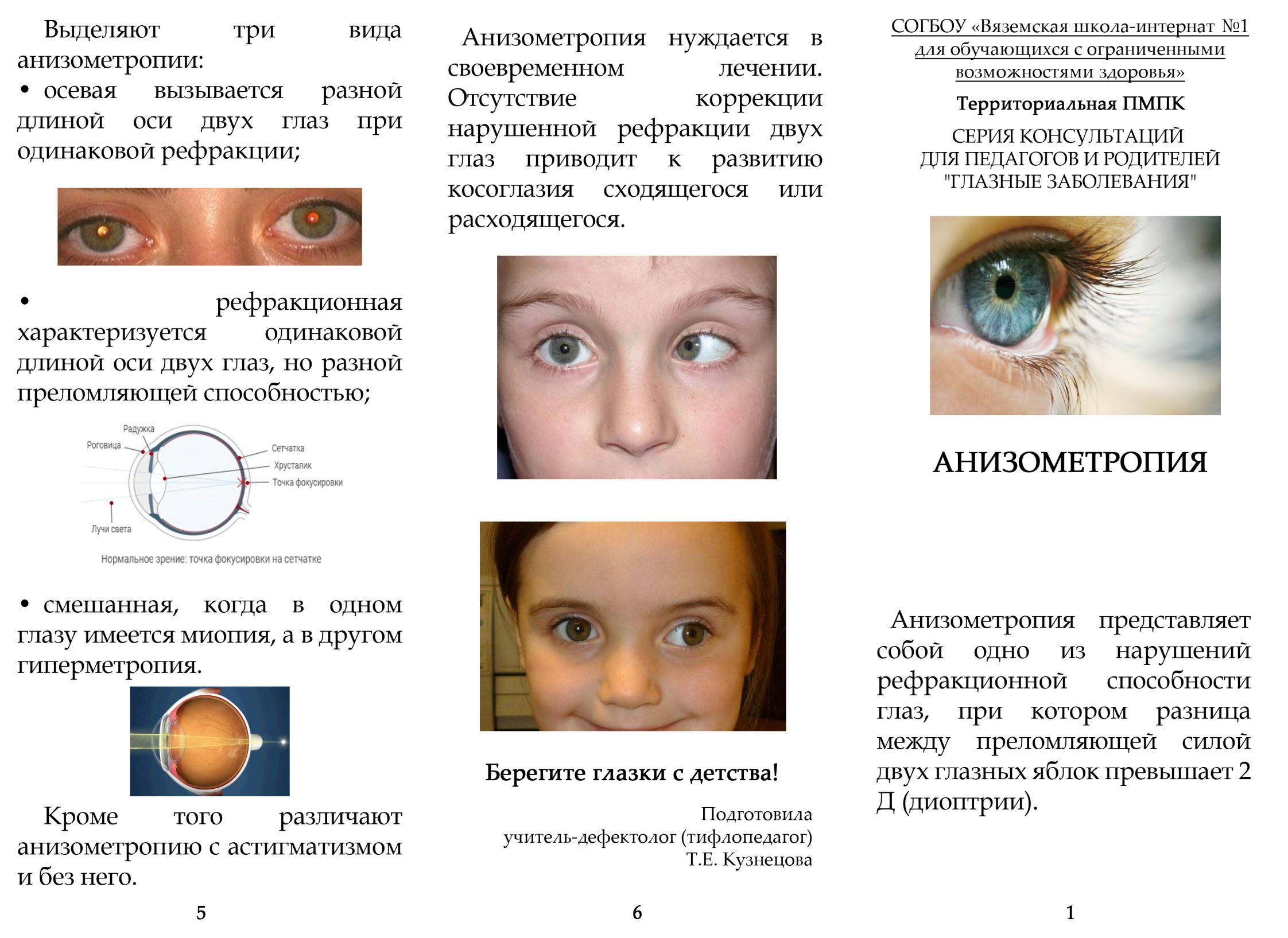 Астигматизм 1 год. Нарушения рефракции глаза астигматизм. Астигматизм сложный гиперметропический обоих глаз у ребенка 3 года. Сложный гиперметропический астигматизм у детей в 1 год. Астигматизм нарушение рефракции глаза при котором.