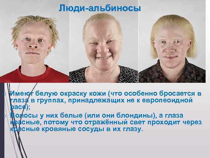 Глазной альбинизм