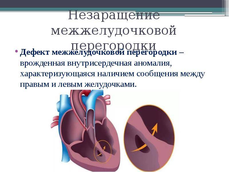 Дефекты перегородок. Врожденный дефект межжелудочковой перегородки. Стеноз межжелудочковой перегородки. Аортальный дефект межжелудочковой перегородки.