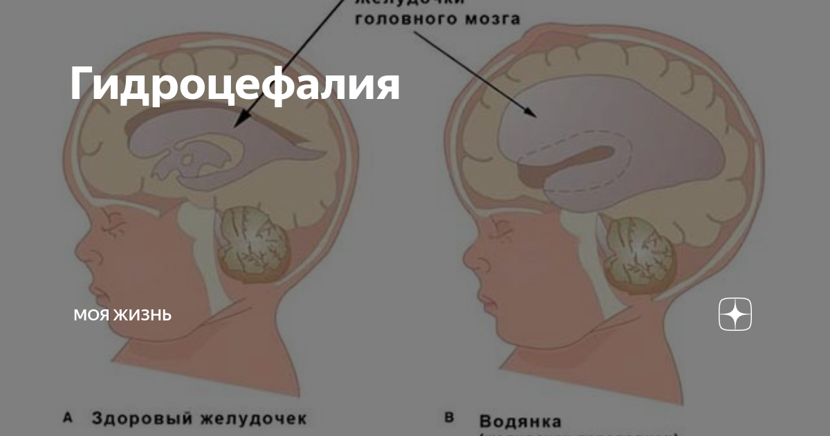 Гидроцефалия мозга симптомы и лечение