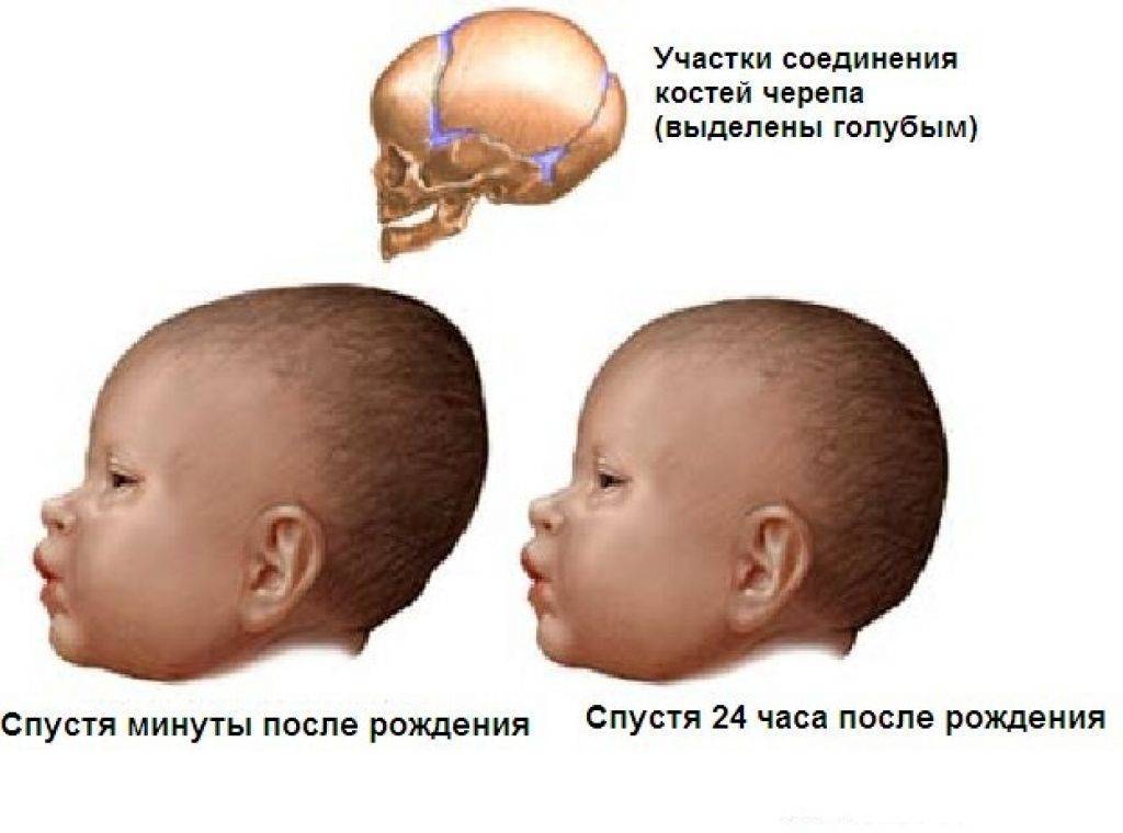 Почему голова вытянутая. Гематома на голове у новорожденного после родов. У грудничка вытянут затылок. Гематома на голове у новорожденного после родов последствия.