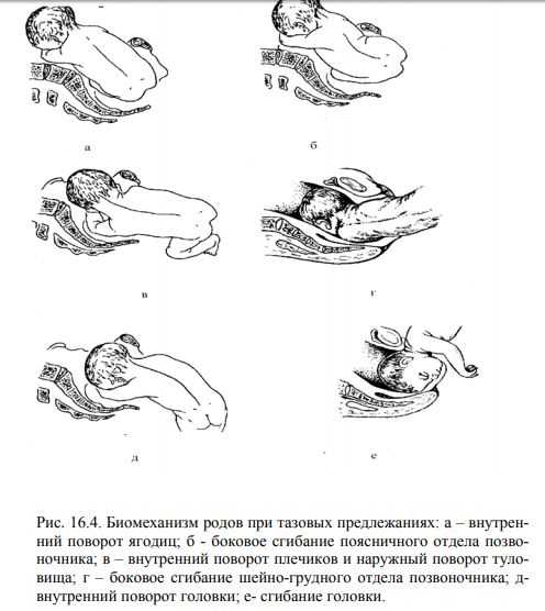 Тазовое предлежание плода
