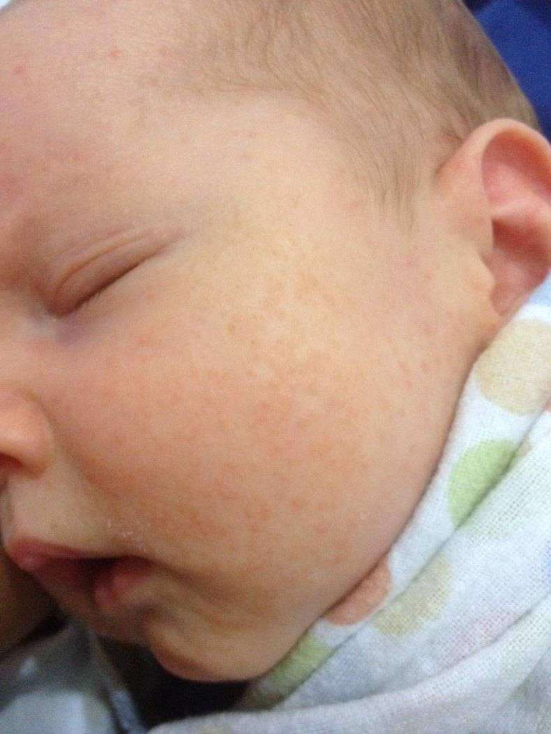 Прыщики на лице новорожденного ребенка: из-за чего появляются и что с ними делать