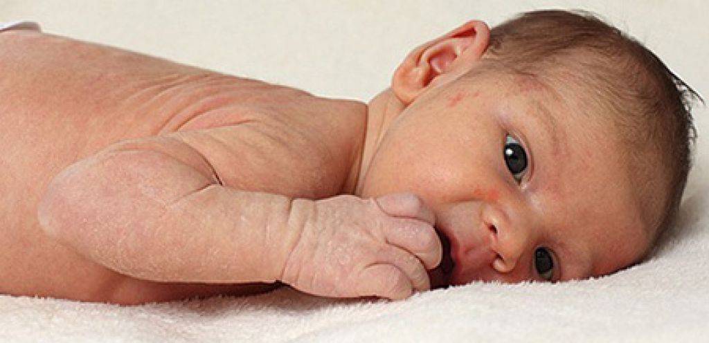 Шелушение кожи у новорожденных | без соски - здоровое развитие ребенка