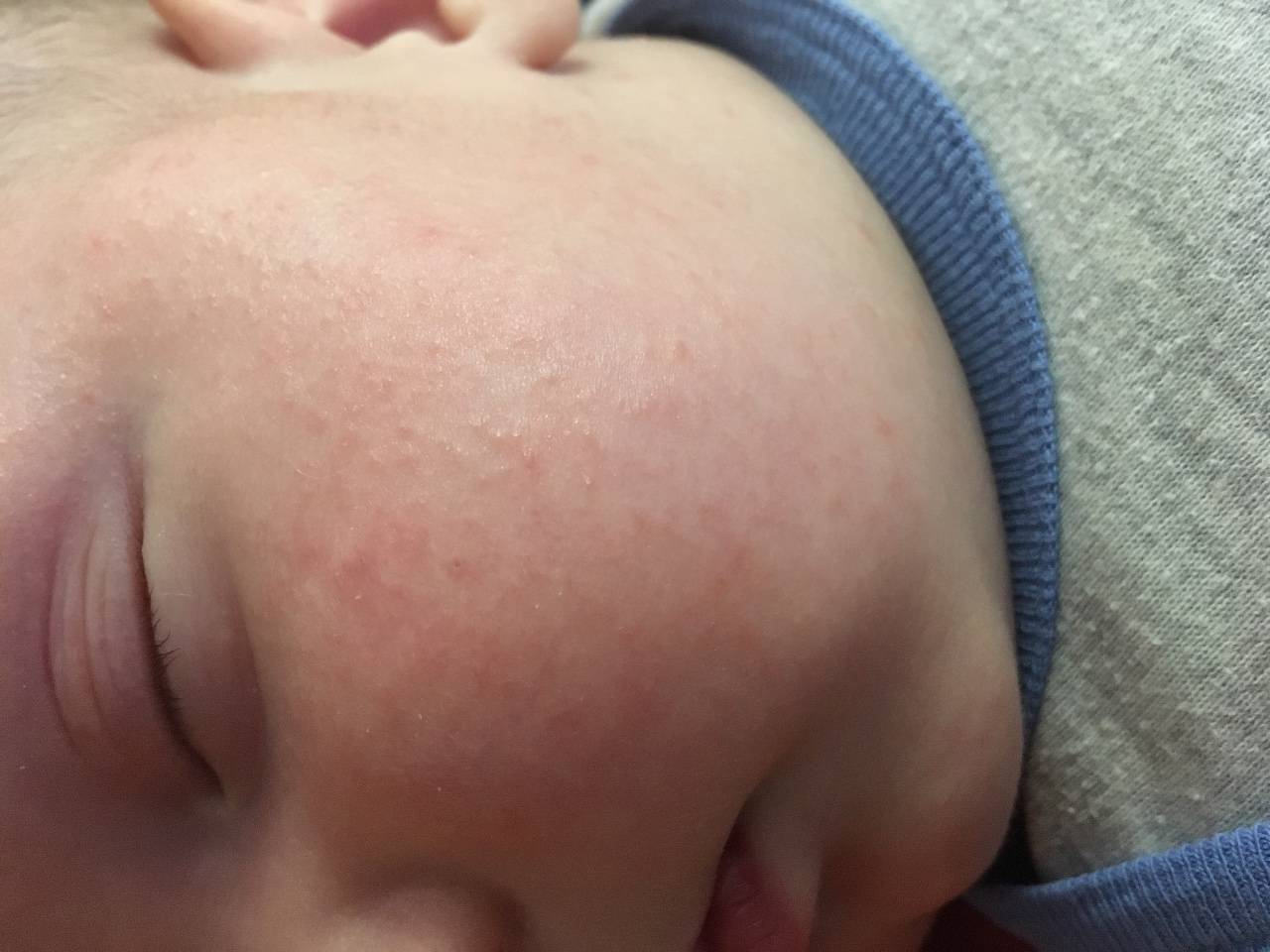 Сыпь у ребенка на лице: возможные причины, все виды высыпаний с фото и методы лечения прыщиков