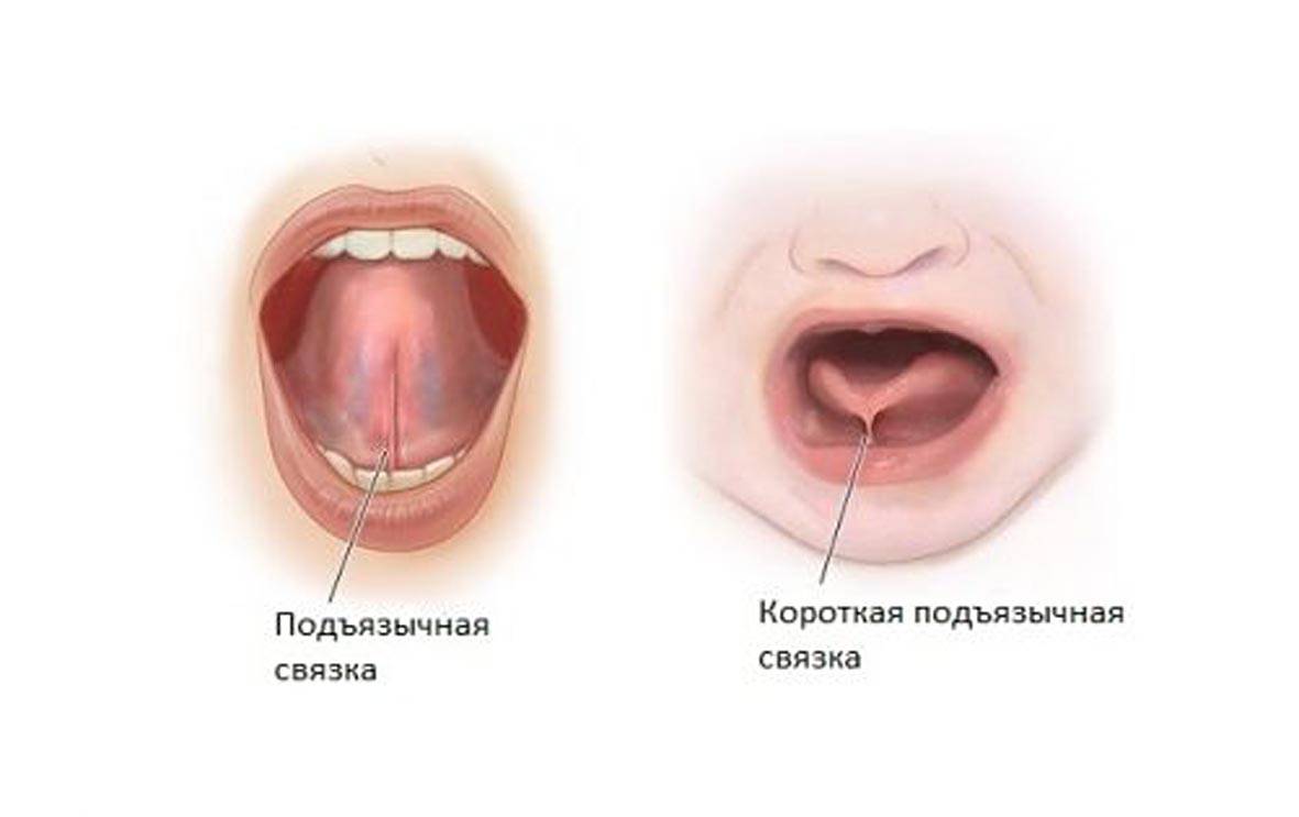 Короткая уздечка языка. подрезать или растягивать?