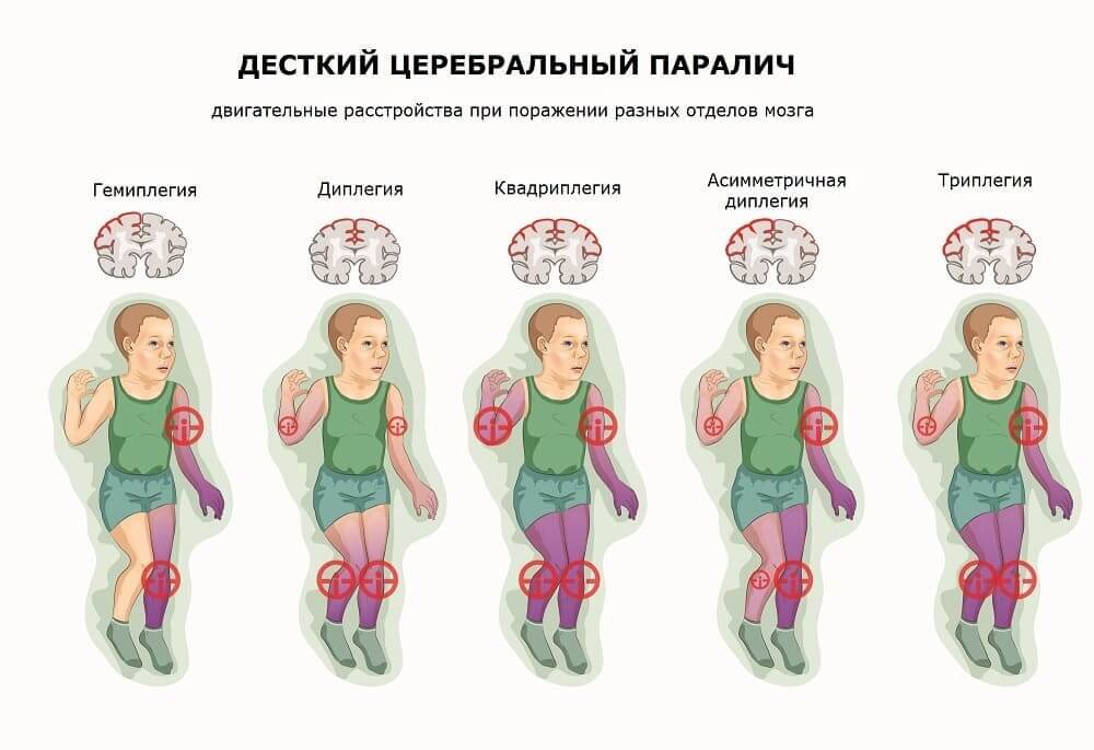 Детский церебральный паралич