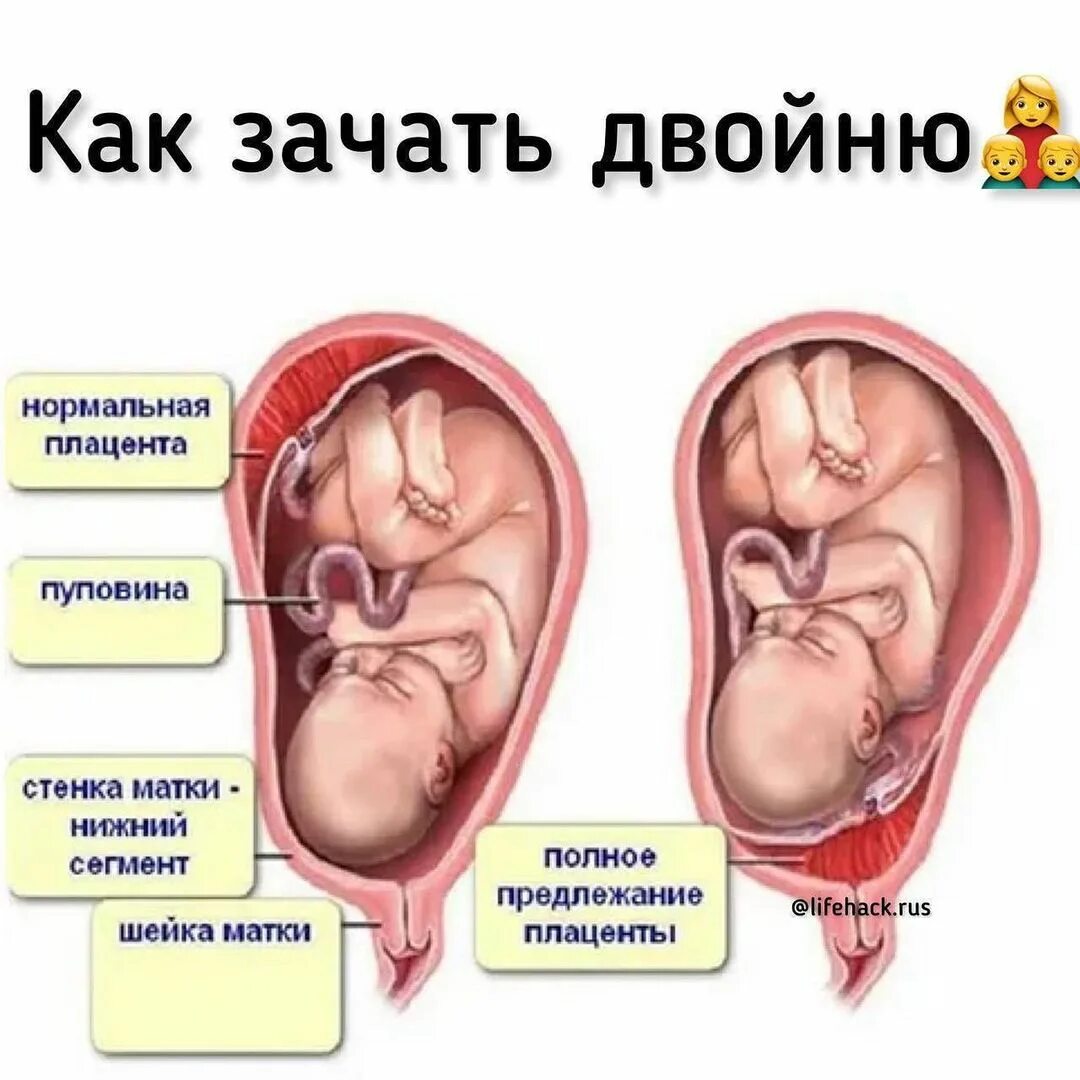 Эффективные способы забеременеть двойней: что нужно делать, как зачать