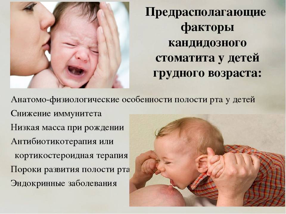 Молочница у новорожденных младенцев и грудничков во рту на языке: симптомы, лечение, эффективные средства, как выглядит