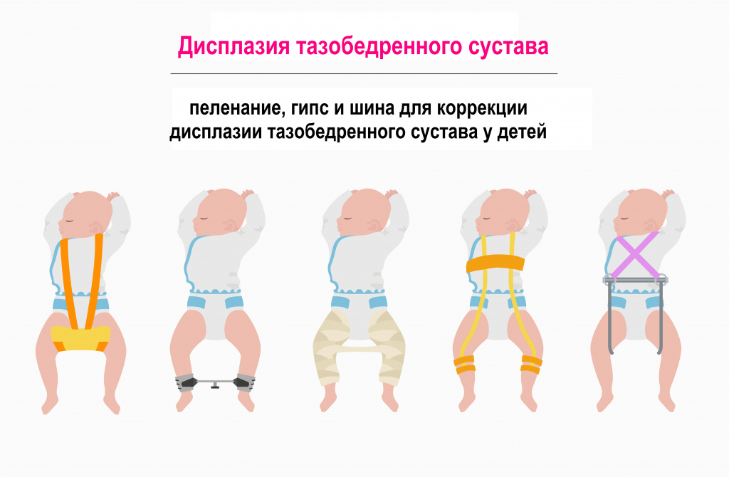 Дисплазия тазобедренных суставов у детей - симптомы, степени, лечение, фото - «медикидс»