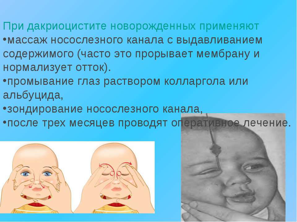 Как делать массаж для открытия слезных каналов при дакриоцистите новорожденному