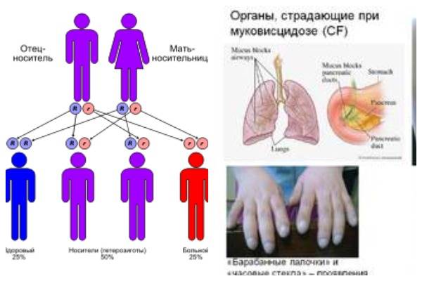 Муковисцидоз это. Муковисцидозом симптомы у новорожденных. Муковисцидоз симптомы у детей 1. Симптомы форм муковисцидоза. Муковисцидоз у новорожденных внешние признаки.