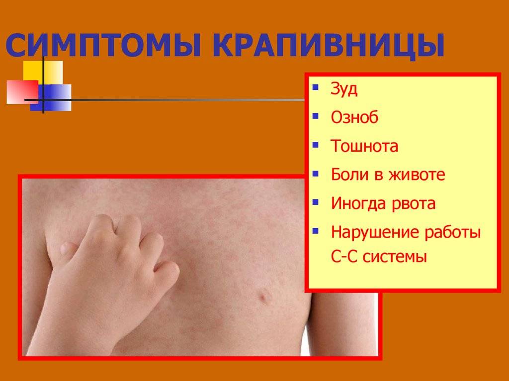 Крапивница: симптомы заболевания у детей, причины, диагностика и способы лечения с фото