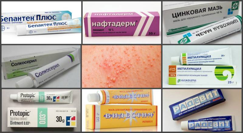 Негормональные мази от аллергии для детей: какие противоаллергические средства лучше выбрать при атопической форме болезни?