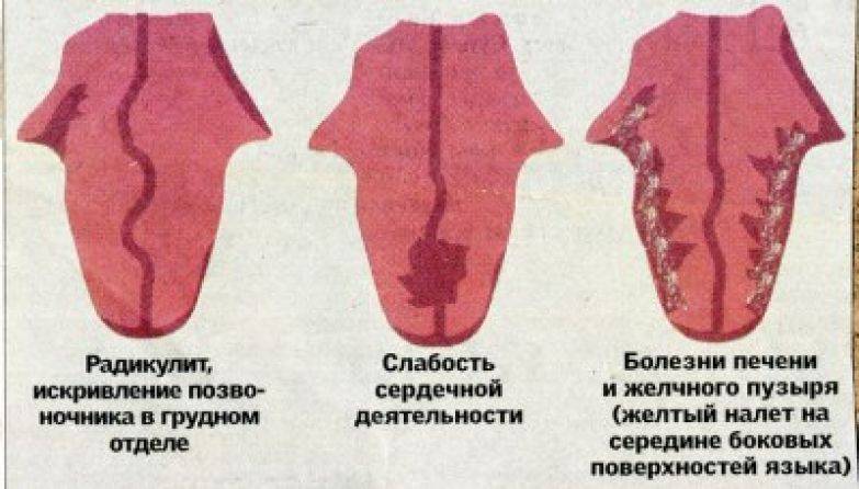 У ребенка на языке пятно как ожог: фото, что это, как лечить