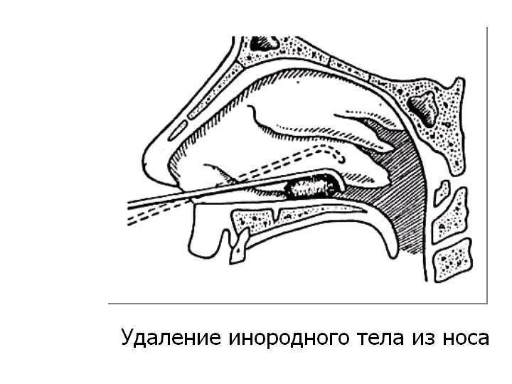 Инородное тело в дыхательных путях у ребенка: признаки, помощь