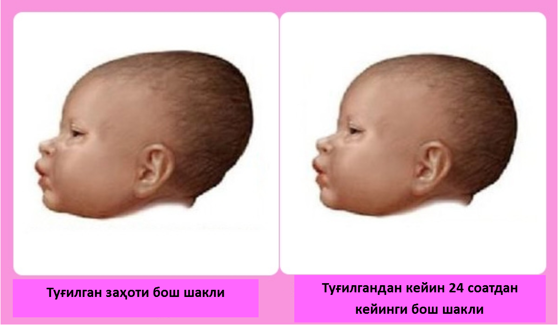 Почему голова вытянутая. Форма головки новорожденного. Форма головы новорожденного. Форма головы у грудничка.