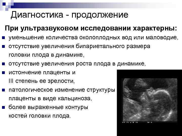 Причины и последствия взвесей в околоплодных водах, лечение и профилактика